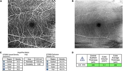 Retinal Optical Coherence Tomography Angiography Parameters Between Patients With Different Causes of Chronic Kidney Disease